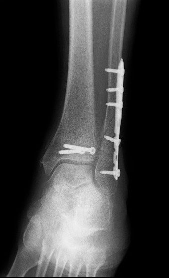 החלפת מפרק קרסול, ניתוח לאחר שבר בקרסול, ניתוח שבר בקרסול אורתופד מומחה כף רגל